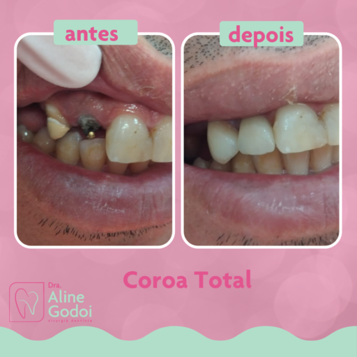 Caso cl nico antes e depois coroa total consult rio odontol gico